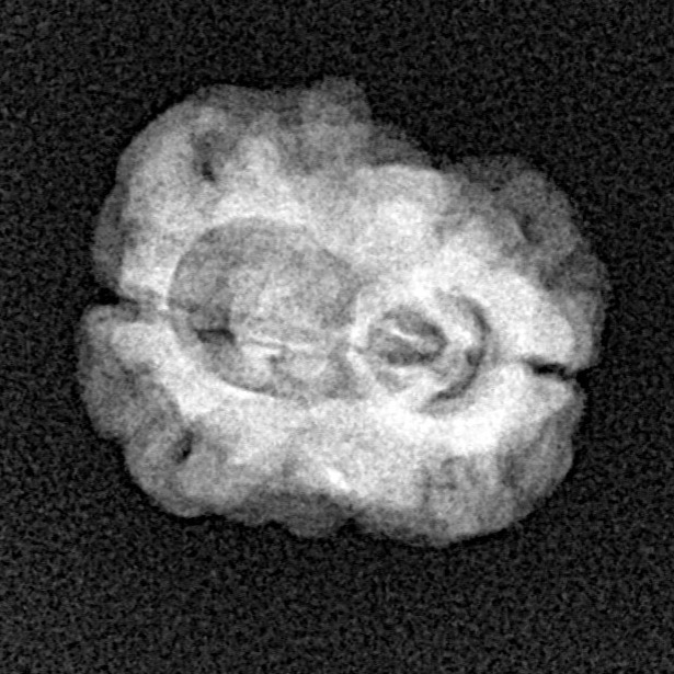 2 Mukhi Rudraksha 22.2mm 1.76gm - Xray