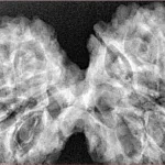 12 MK Gaurishankar 44.4mm 8.83gm - Xray