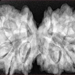 12 MK Gaurishankar 38.6mm 9.7gm - Xray