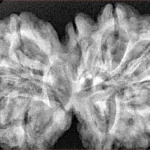 11 MK Gaurishankar 38.7mm 8.52gm - Xray