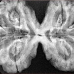 8 MK Gaurishankar 41.1mm 10.62gm - Xray