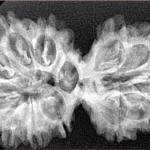 12 MK Gaurishankar 36.8mm 5.32gm - Xray
