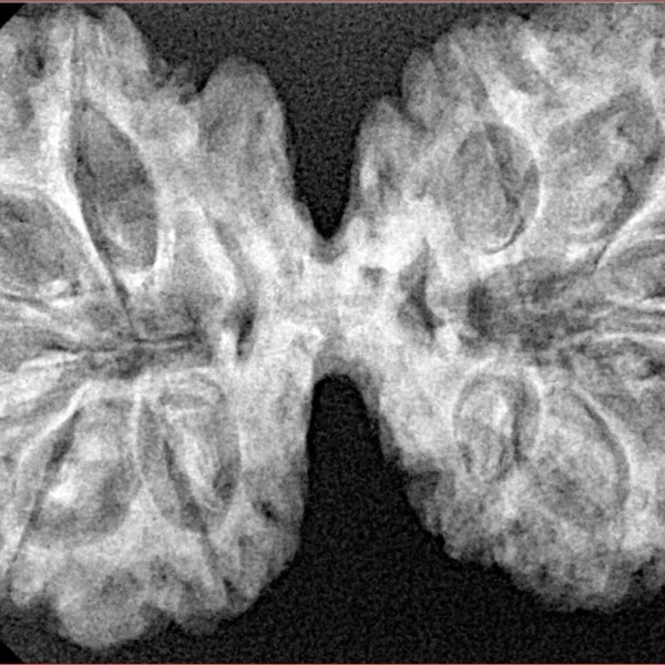 11 MK Gaurishankar 38.1mm 6.35gm - Xray