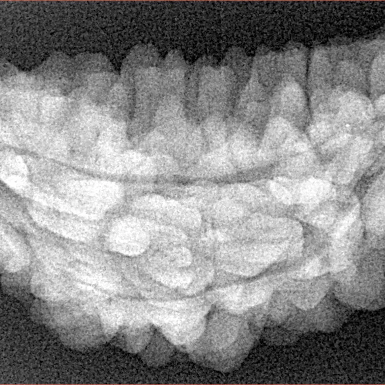 1 Mukhi Rudraksha 36.2mm 5.5gm - Xray