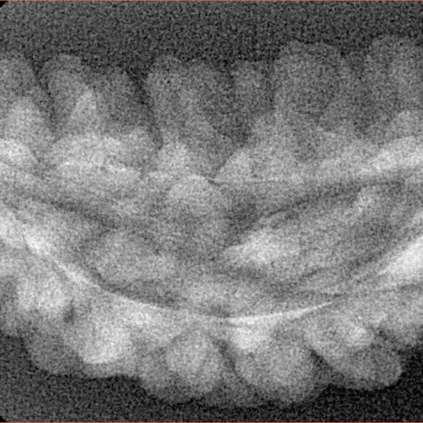 1 Mukhi Rudraksha 38.6mm 3.02gm - Xray