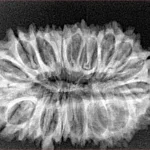 21 Mukhi Rudraksha 30.8mm 4.1gm - Xray