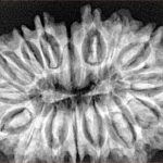 16 Mukhi Rudraksha 33.8mm 5.85gm - Xray