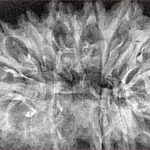 16 Mukhi Rudraksha 40.2mm 3.8gm - Xray